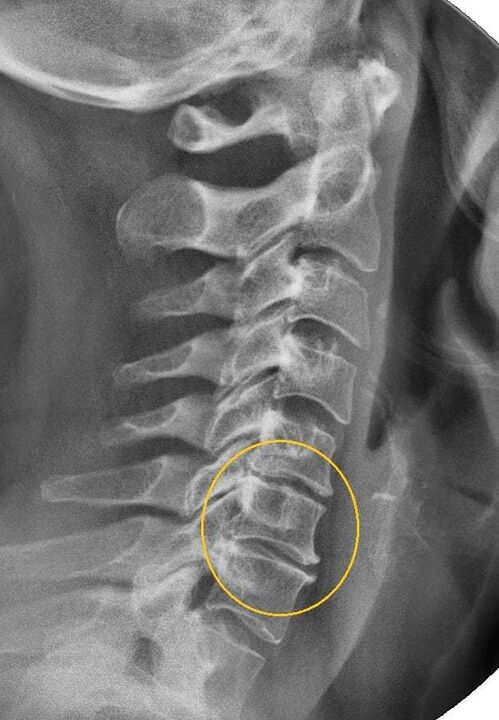 osteochondróza