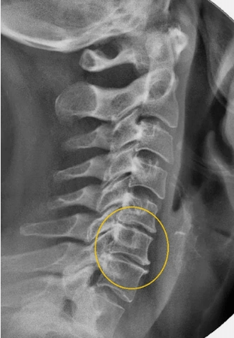 Osteochondróza krčnej chrbtice na x -roy