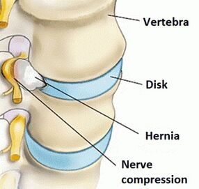 Osteochondróza krčnej oblasti