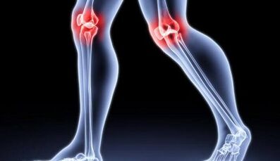 Prevencia rozvoja artritídy a artrózy
