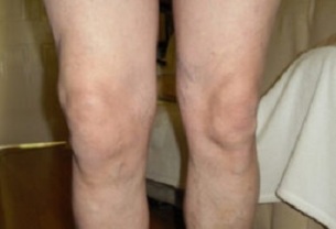 prejavy artrózy kolenného kĺbu (1)