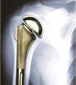 Náhrada ramena pri artróze