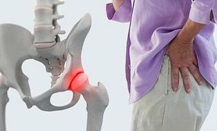 príčiny artrózy bedrového kĺbu