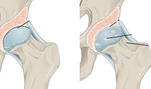 štádia vývoja artrózy bedrového kĺbu