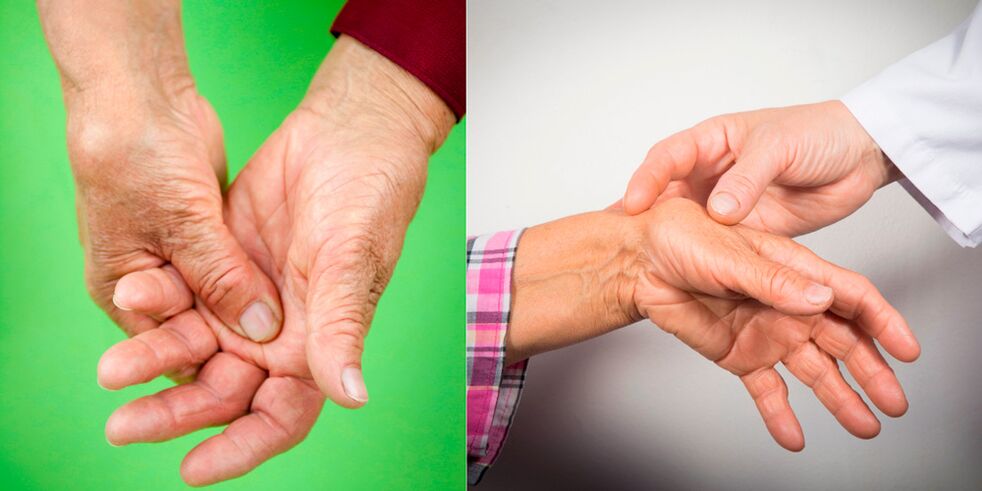 opuch a boľavé bolesti sú prvými príznakmi artritídy v ruke