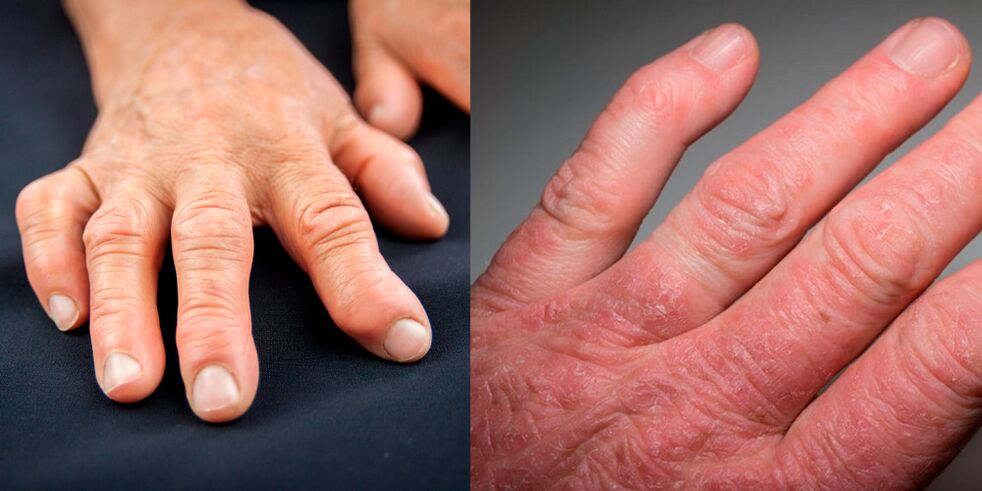 reumatoidná a psoriatická artritída rúk
