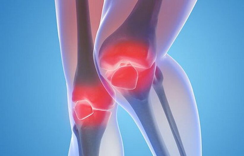artróza kolenných kĺbov