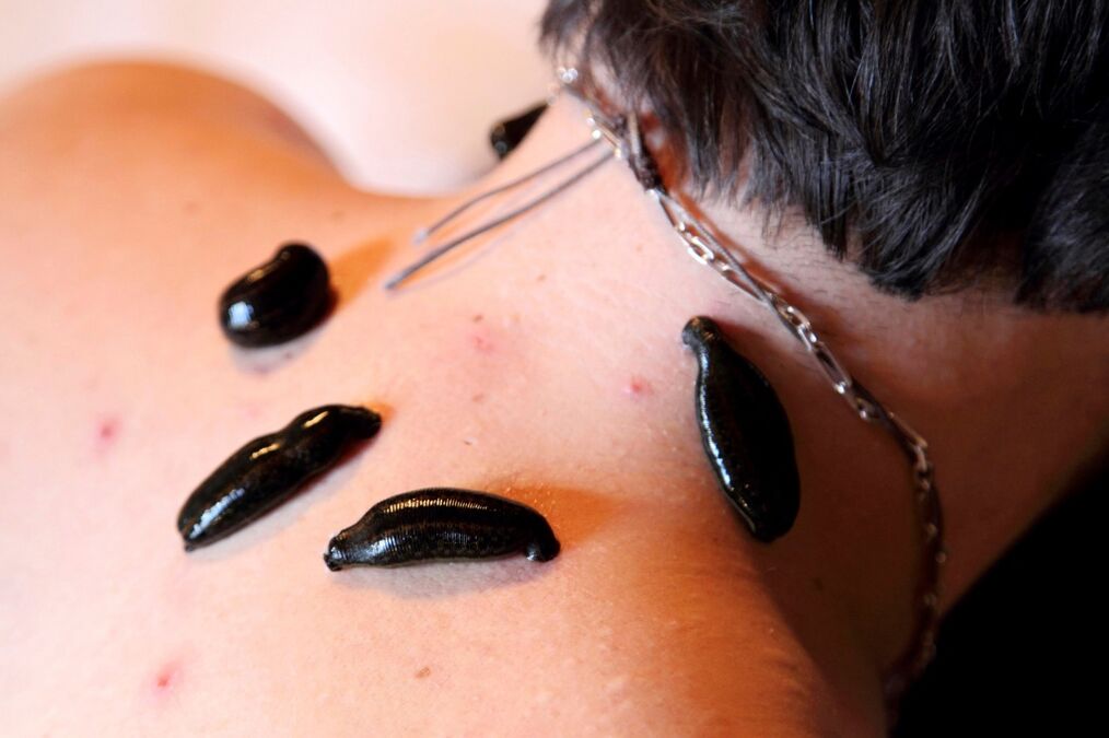 pijavice na cervikálnu osteochondrózu