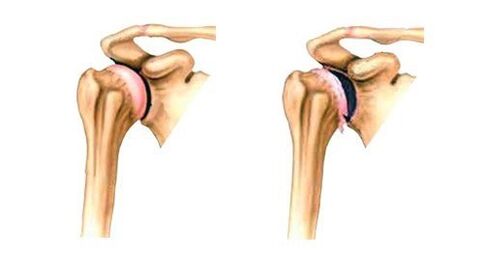 zdravý a artrotický ramenný kĺb