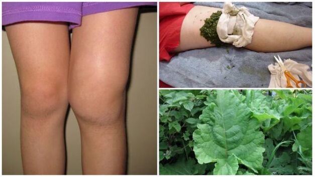 bylinný obklad na artrózu kolena