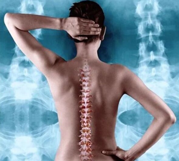 osteochondróza chrbtice a hrudníka