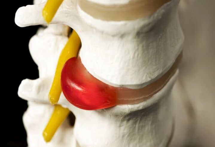 kýla chrbtice ako príčina bolesti v oblasti lopatiek
