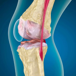 Osteoartróza kolena