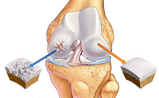 osteoartróza kolena